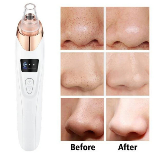Face Vacuum Suction Blackhead Remover Machine | Deep Cleansing For Nose & Face